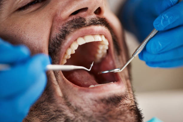 Best Emergency Dentist for Lost Fillings or Crowns in Lake Wynonah, PA